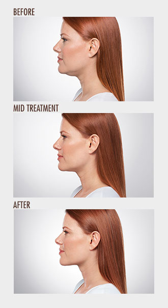 Before and After KYBELLA